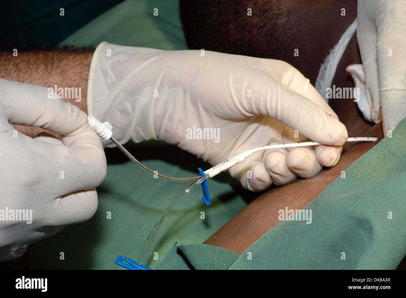 Jugular vein catheter hires stock photography and images Alamy