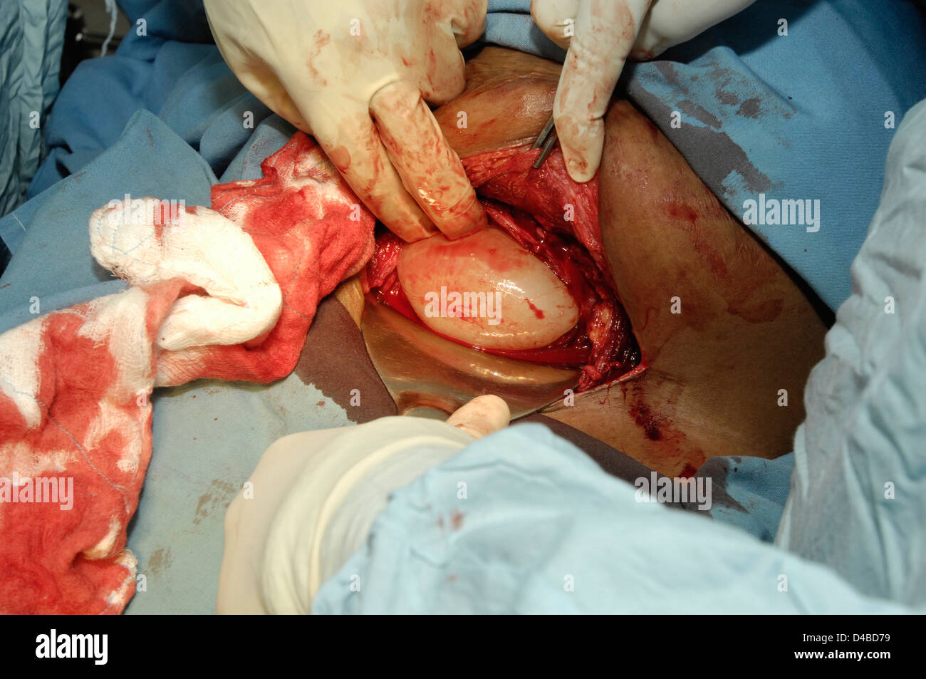 Cesarean delivery. Bladder blade is placed into wound to enable team to have maximal exposure to uterus Stock Photo