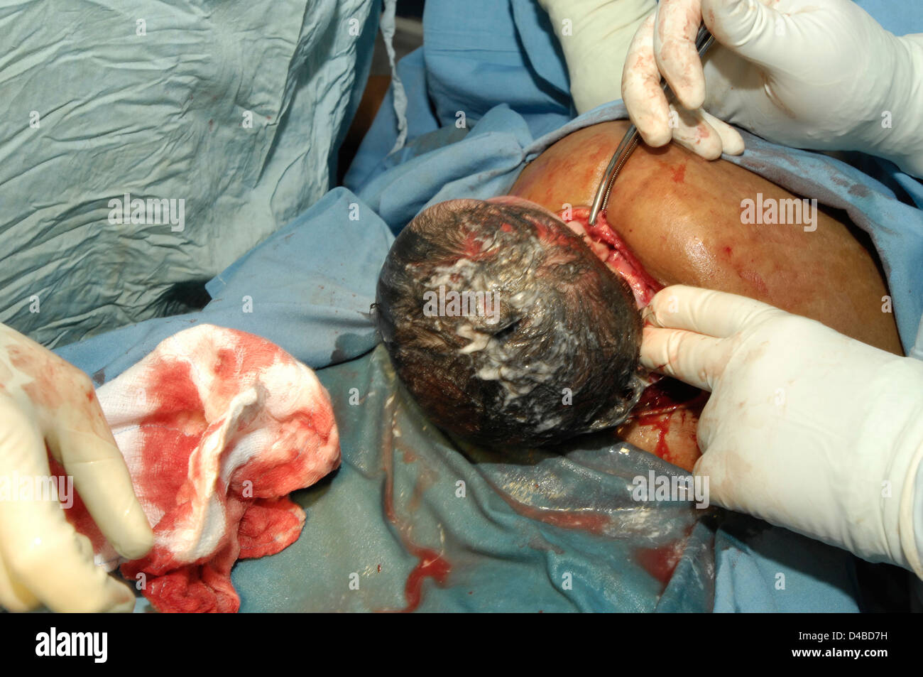 Cesarean delivery. Baby's head emerging from wound out of its mother's uterus Stock Photo