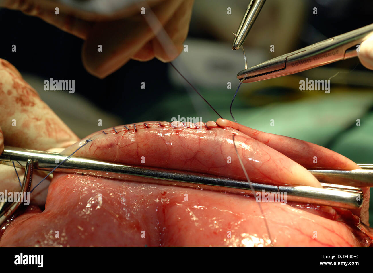 Non-absorbable sutures are used to secure two sections together before anastomosis Stock Photo