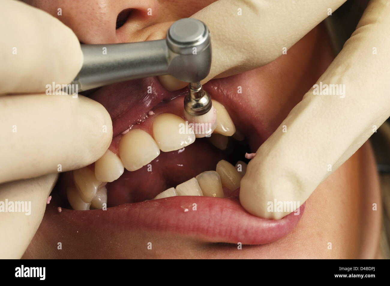 Dentist polishing womens teeth Stock Photo Alamy