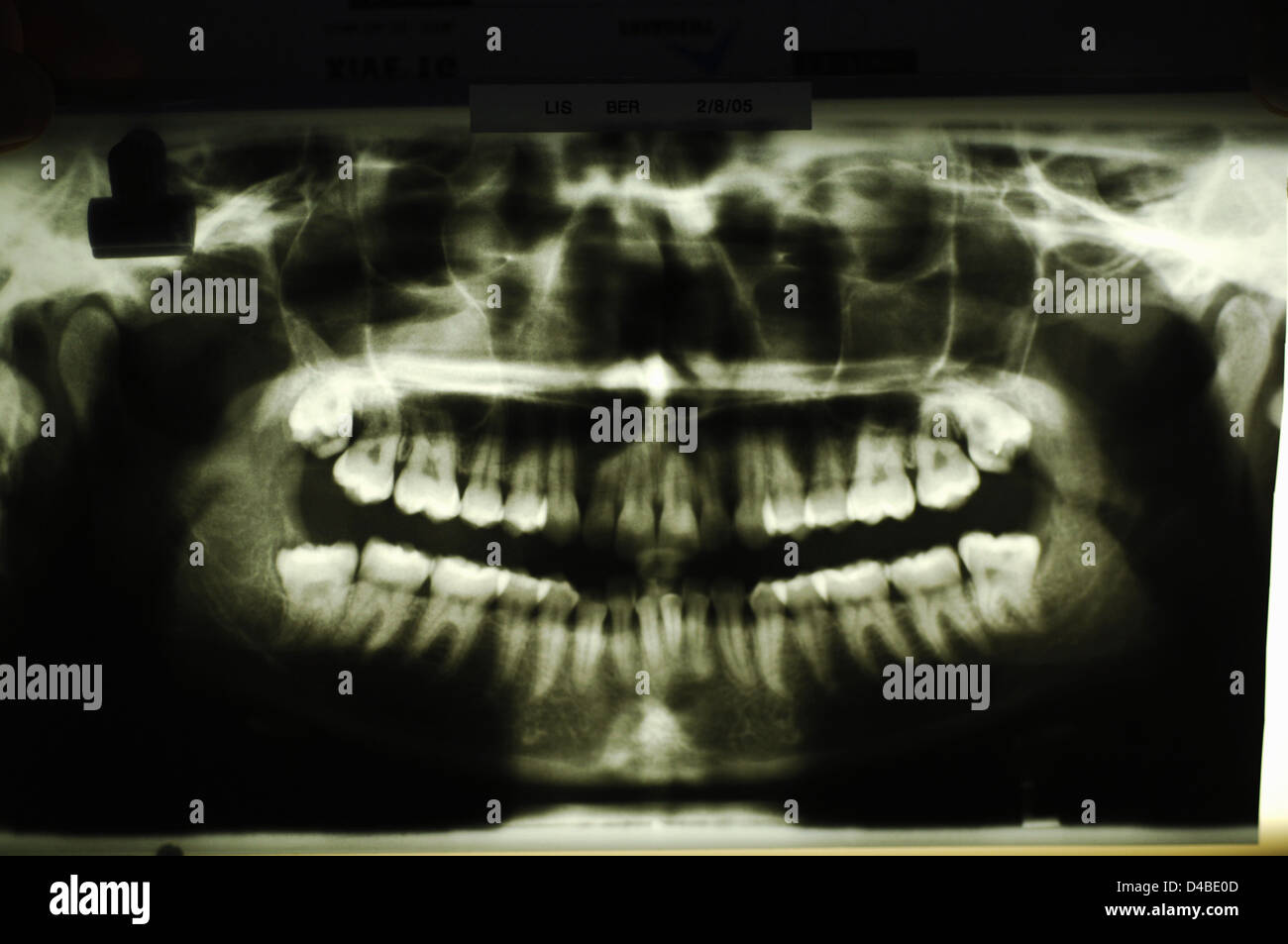 Dental xrays showing teeth Stock Photo Alamy
