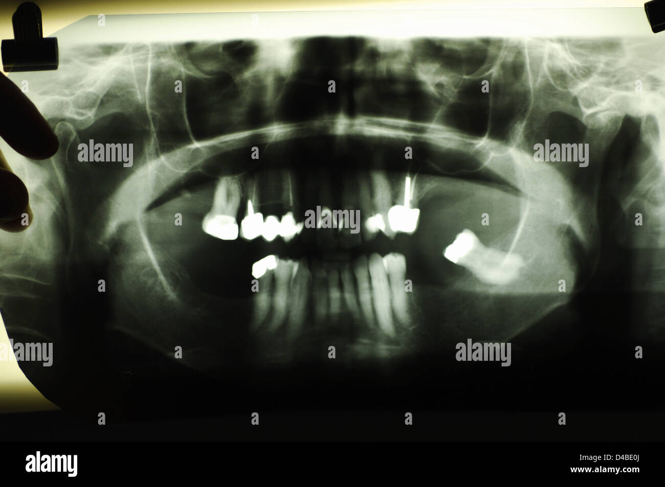 Dental x-rays showing teeth Stock Photo