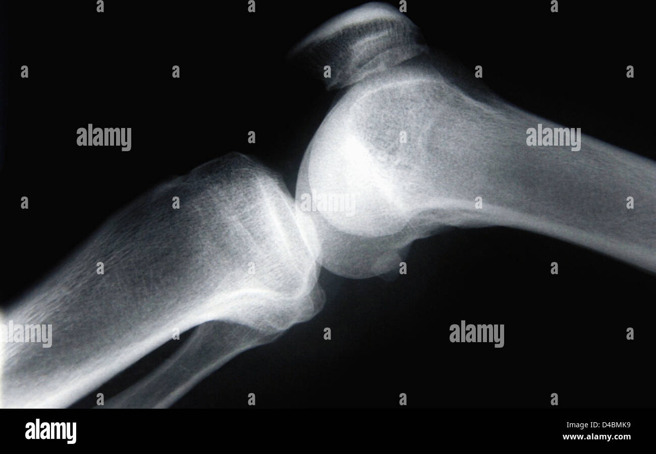 X ray image of female knee joint hi-res stock photography and images ...