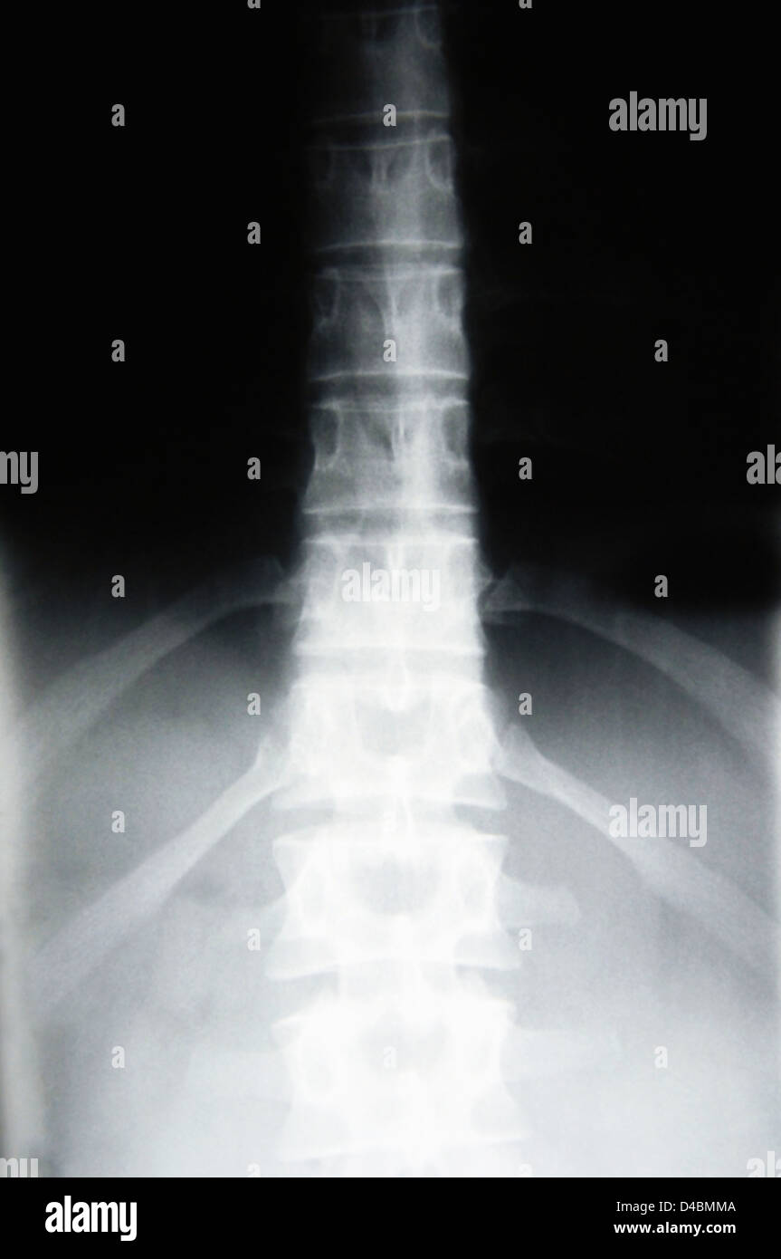 X ray lower back hires stock photography and images Alamy