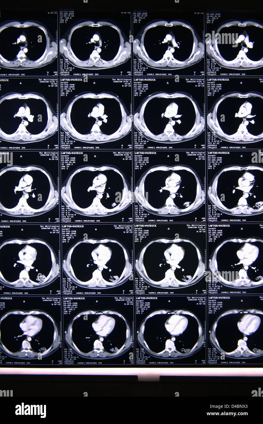 Several sets serial CT scans taken through body radiodense vertebrae