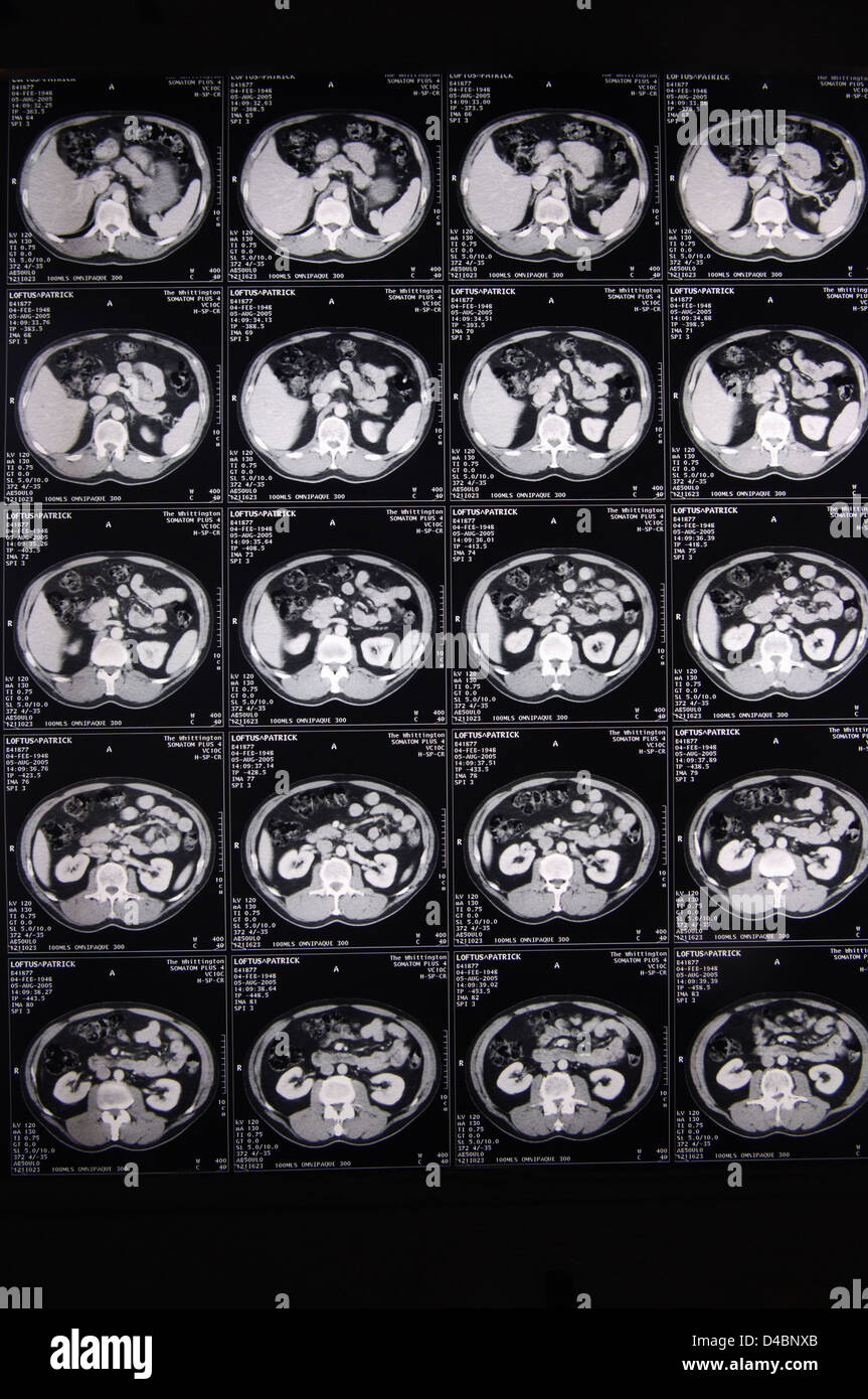 Several sets serial CT scans taken through body radio-dense vertebrae can  be seen towards bottom each individual scan Scans Stock Photo - Alamy