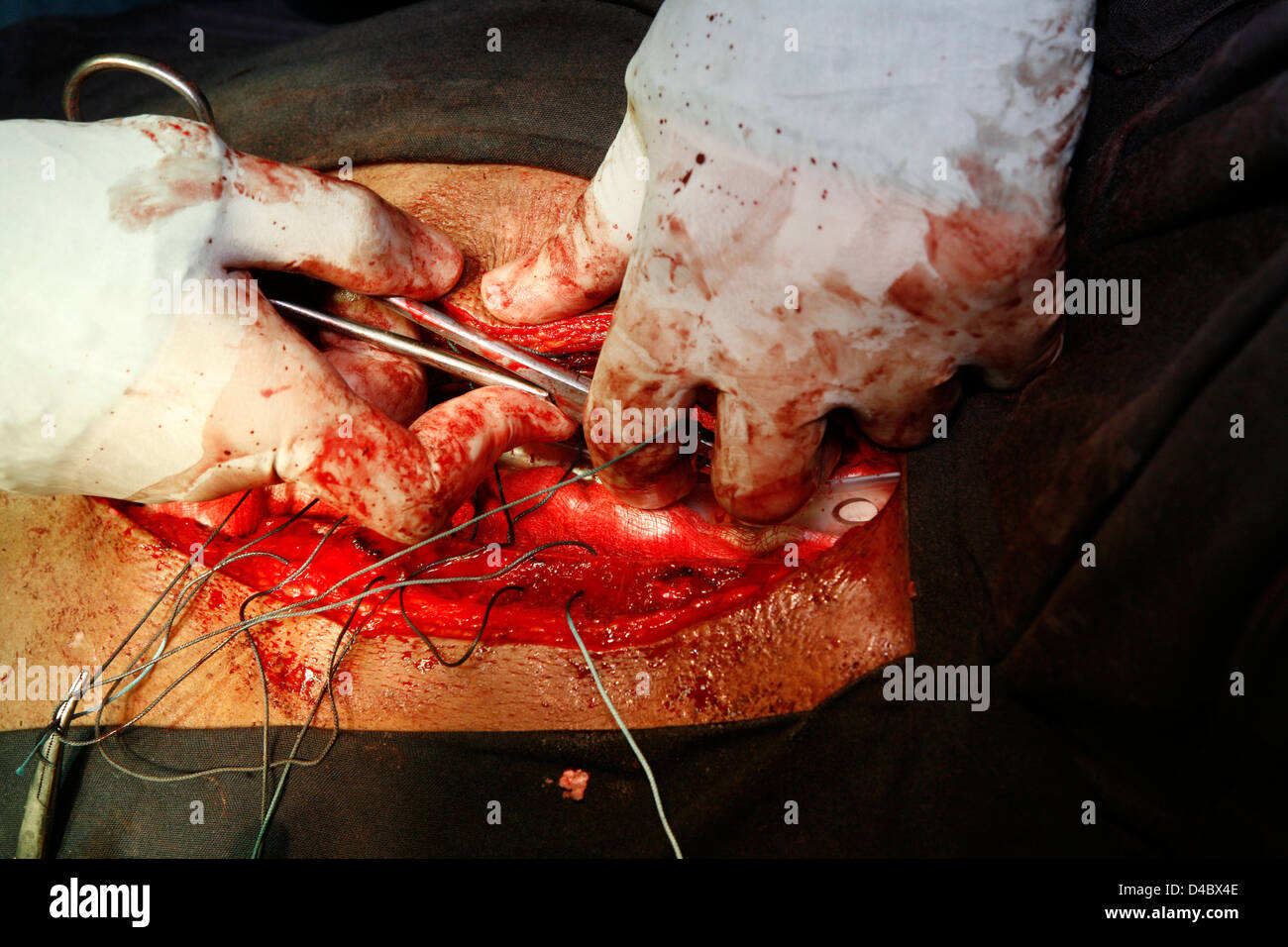 Surgeons stitching a surgical wound. Close-up Stock Photo