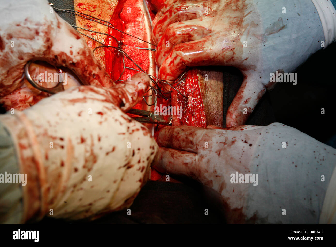 Surgeons stitching a surgical wound. Close-up Stock Photo