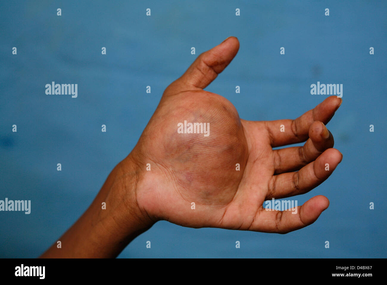 Large neurofibroma growing on woman's hand Stock Photo