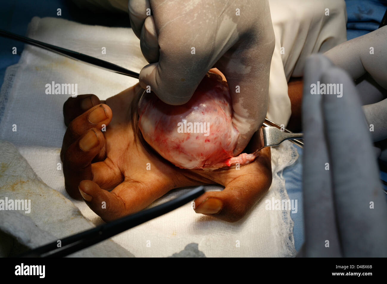 Surgeons operating to remove neurofibroma tumor from patient's hand Stock Photo