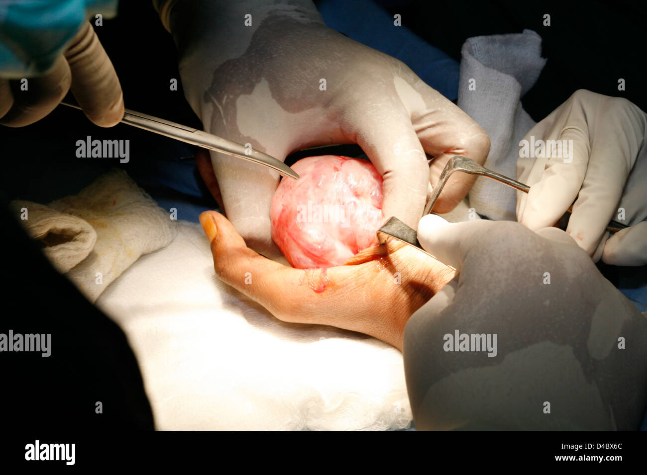Surgeons operating to remove neurofibroma tumor from patient's hand Stock Photo