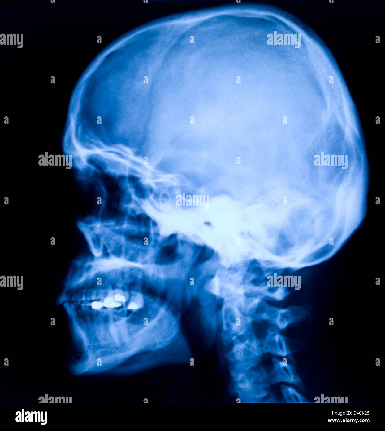 Skull xray hires stock photography and images Alamy