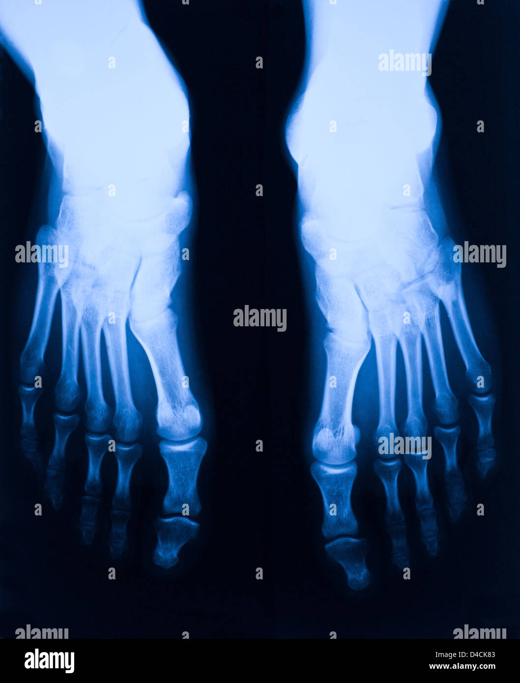 image of blue foot xray Stock Photo