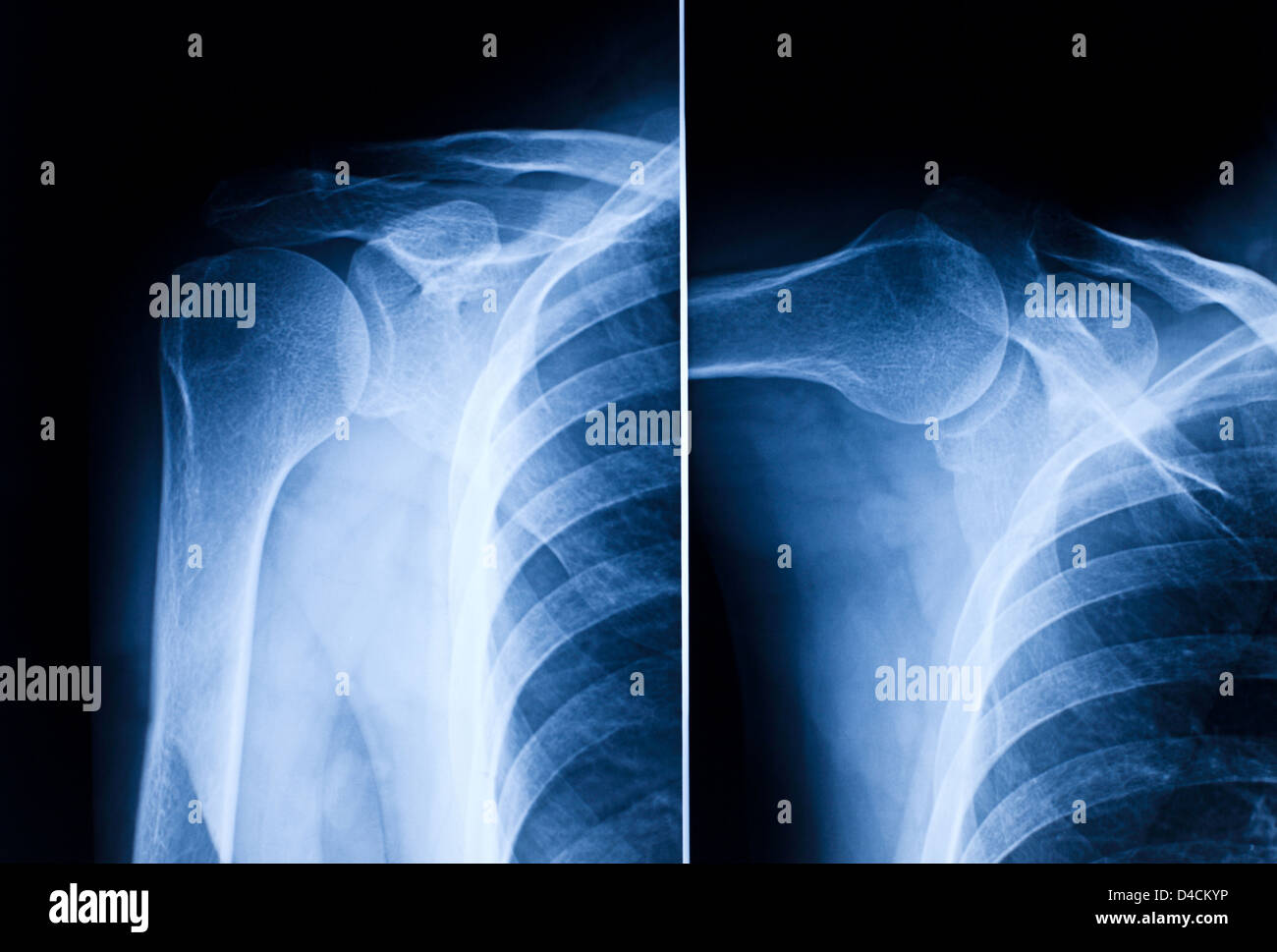 image of shoulder blue xray Stock Photo