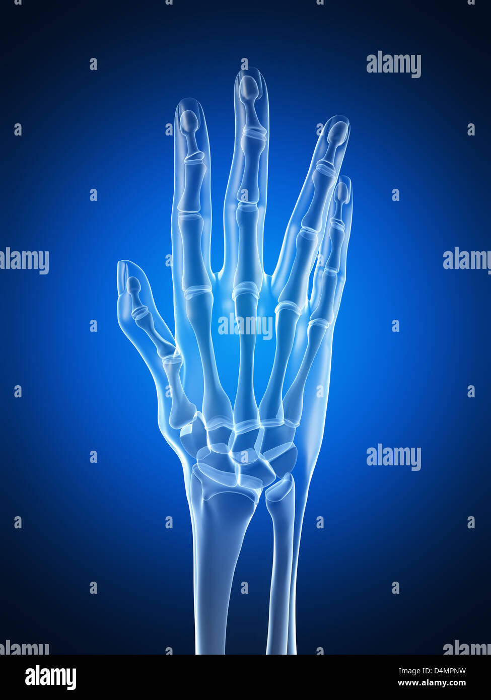 Xray hand arthritis Stock Photo Alamy