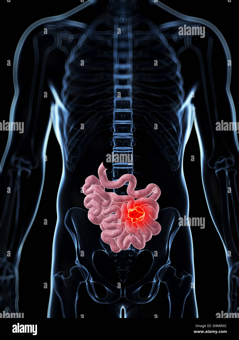 Male small intestine - cancer Stock Photo - Alamy