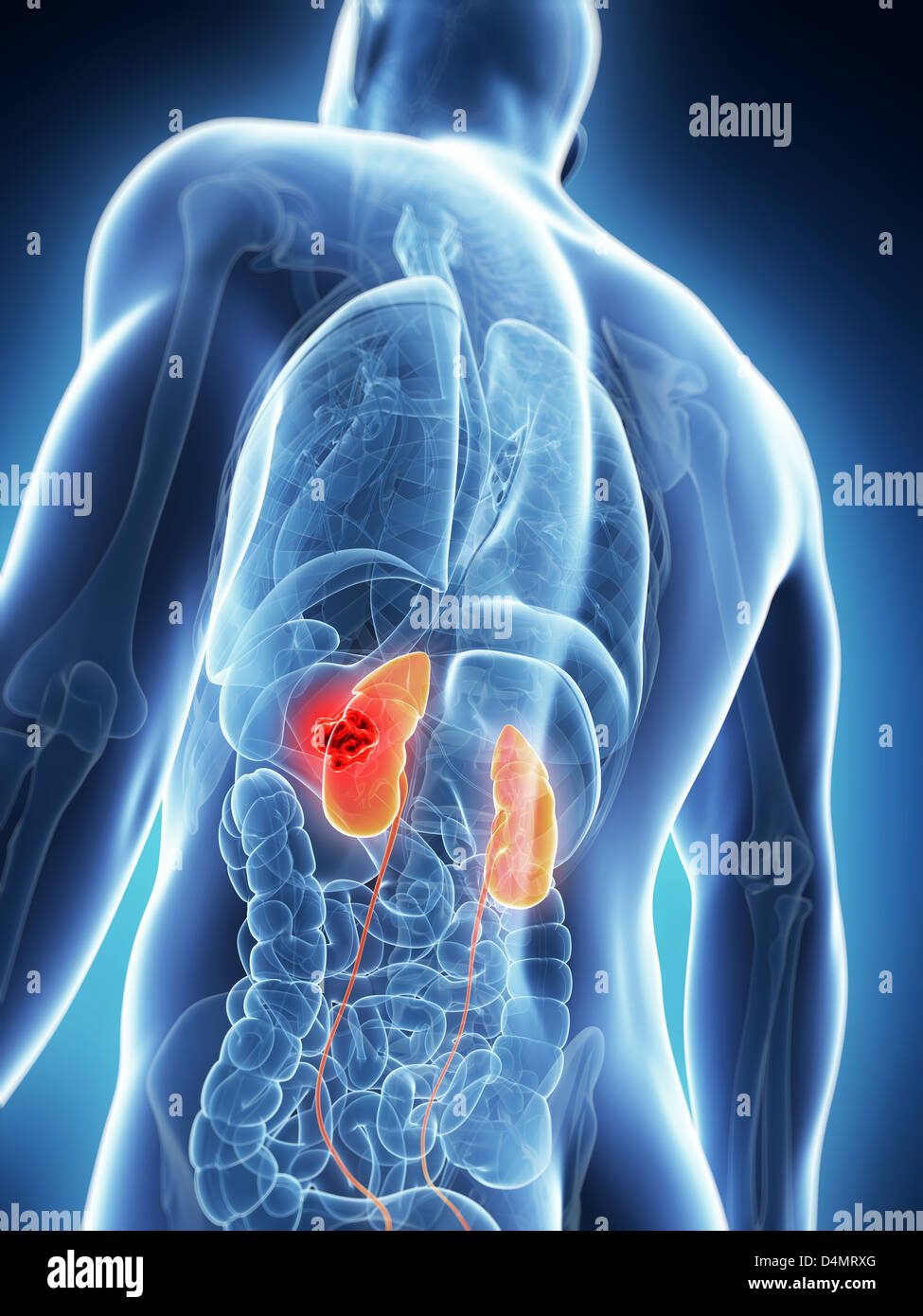 Male kidneys - cancer Stock Photo