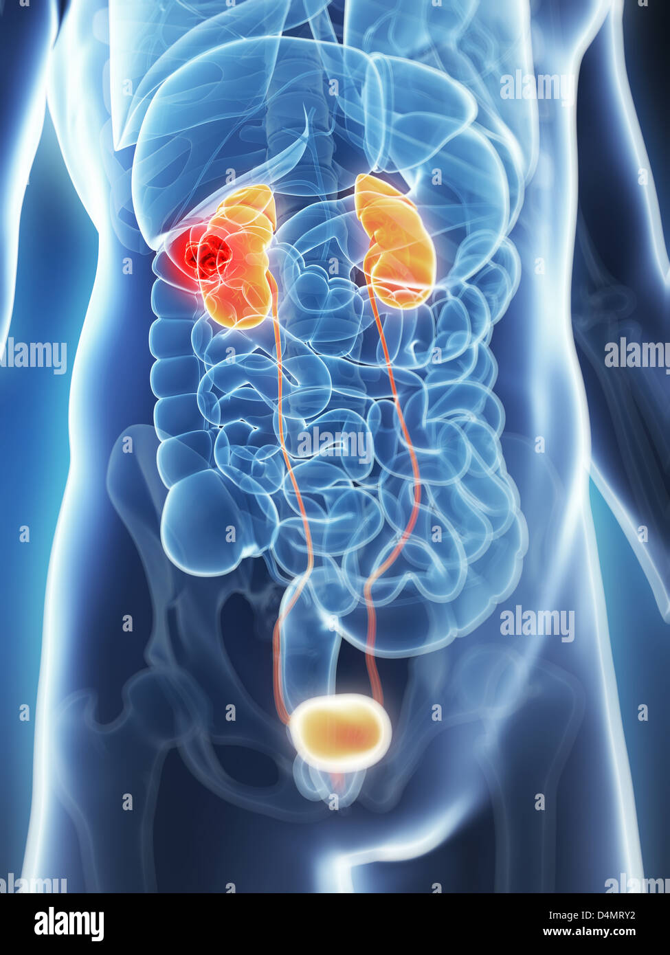 Male kidneys - cancer Stock Photo