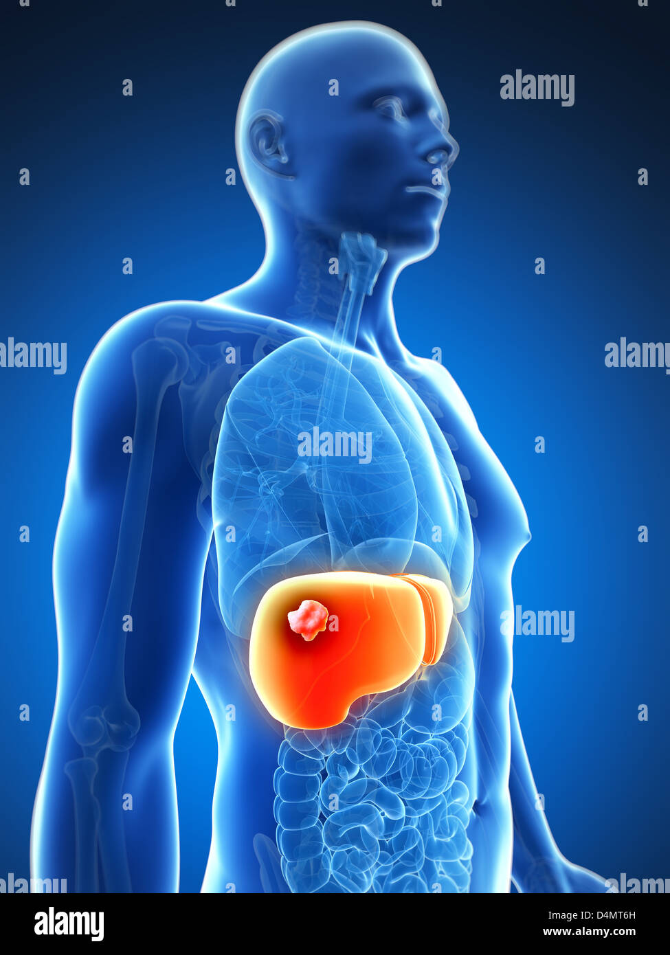Male liver - cancer Stock Photo