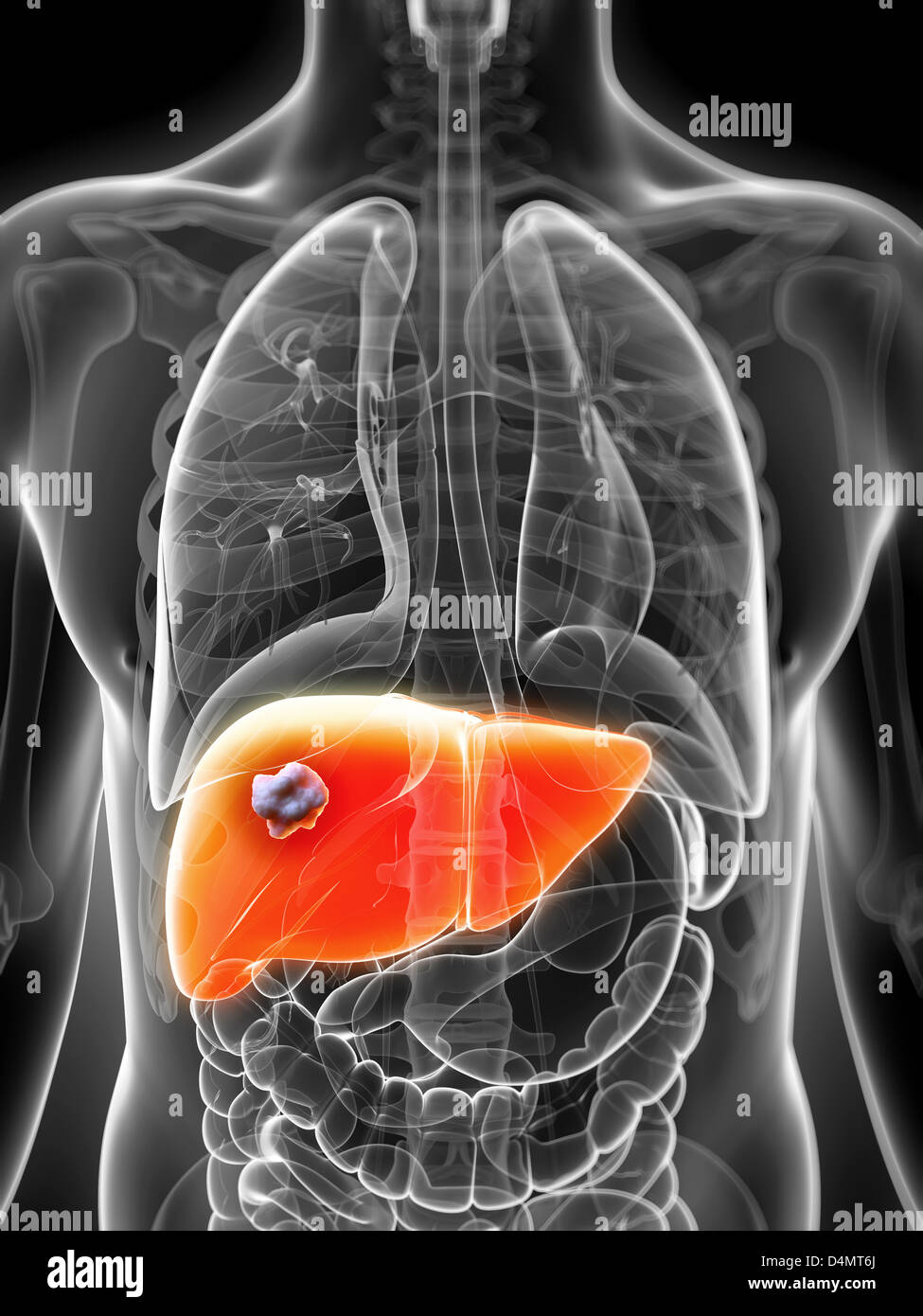 Male liver - cancer Stock Photo
