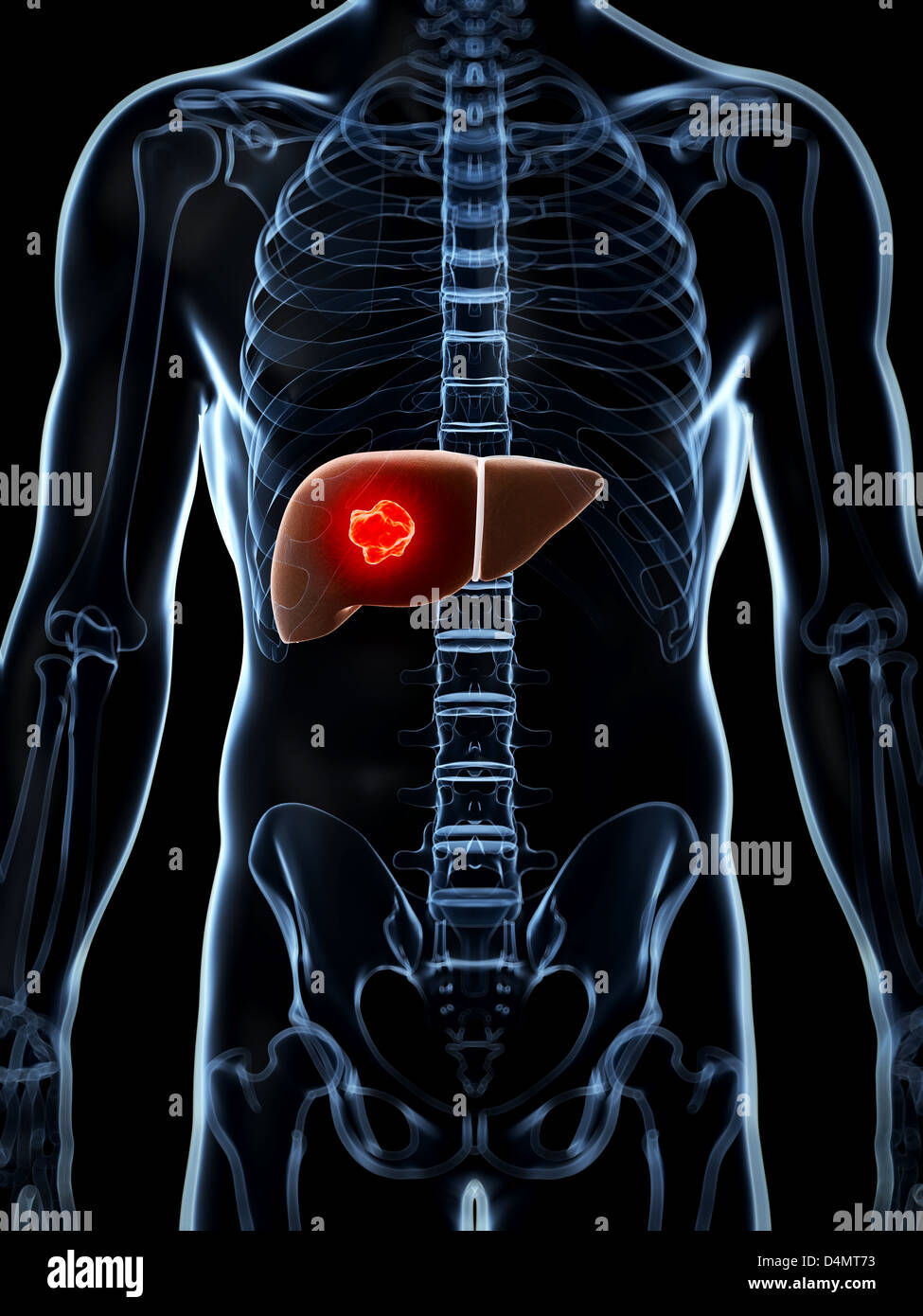 Healthy liver cirrhosis hi-res stock photography and images - Alamy