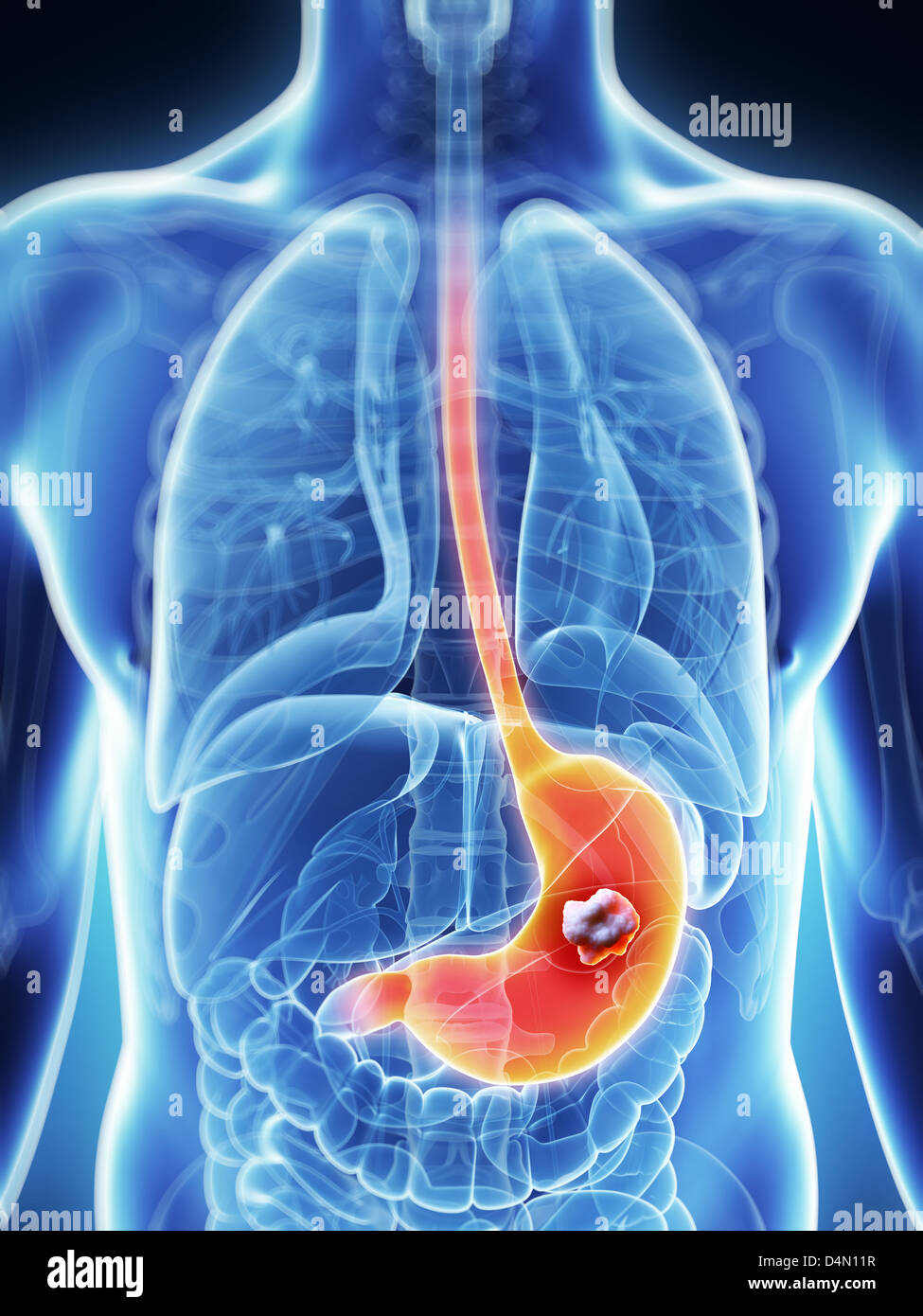 Stomach - cancer Stock Photo - Alamy