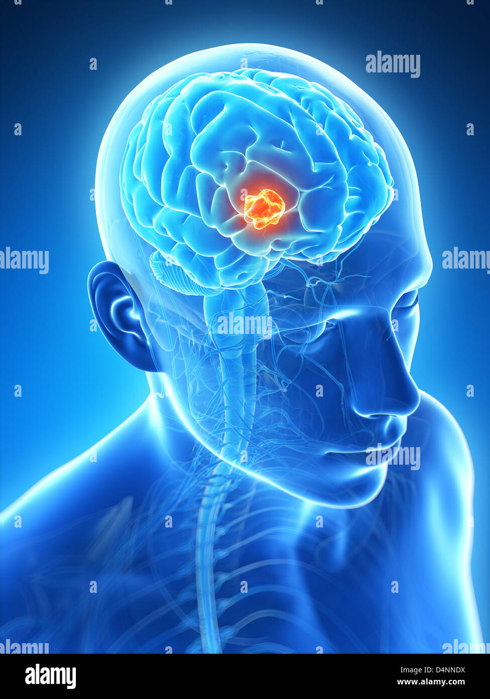 Brain tumor Stock Photo