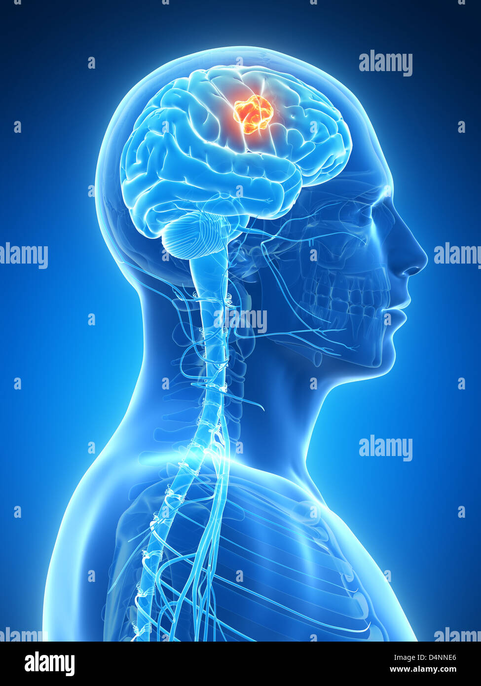 Brain tumor anatomy hi-res stock photography and images - Alamy