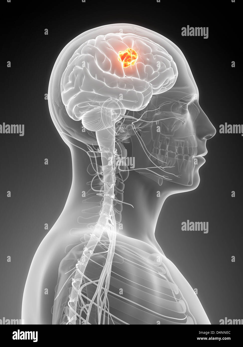 Brain Cancer Concept Anatomical Shape Of Brain Lies Near Word Cancer  Surrounded By Set Of Tests Analysis Drugs Mri Of Skull And Stethoscope  Diagnosis Treatment Of Brain Cancerous Tumors Stock Photo 