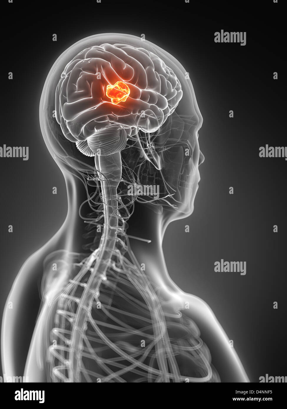 Brain tumor Stock Photo