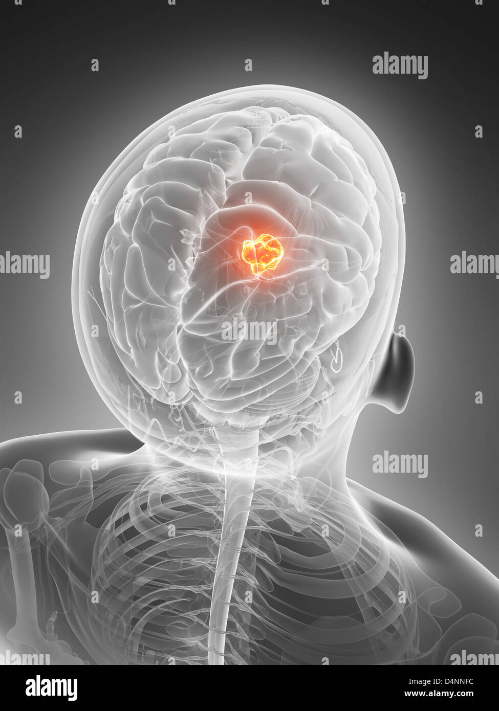 Brain tumor Stock Photo