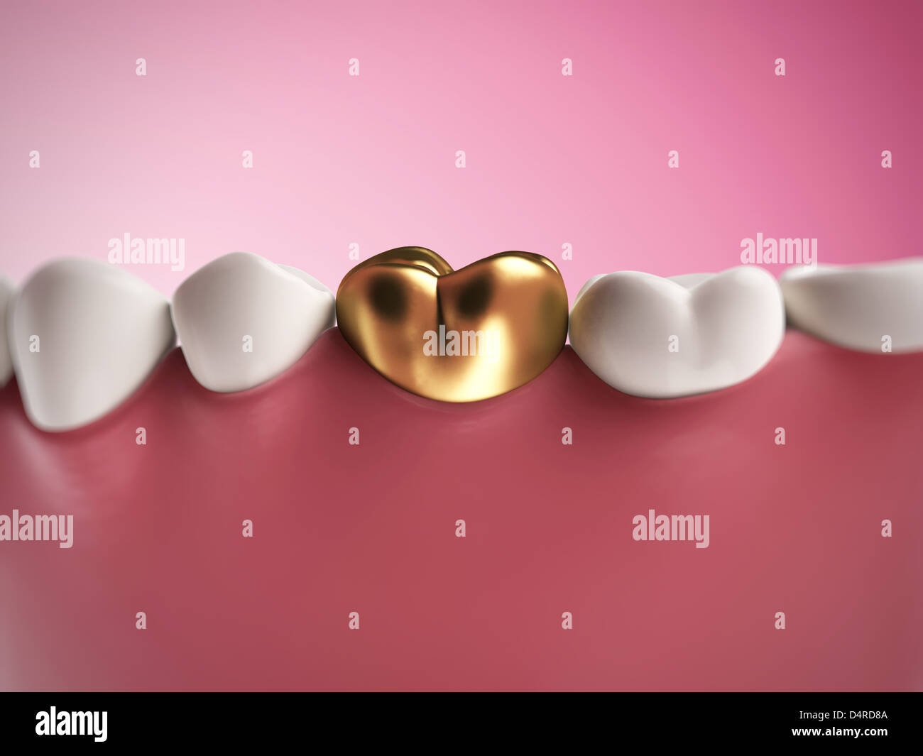 Golden tooth Stock Photo