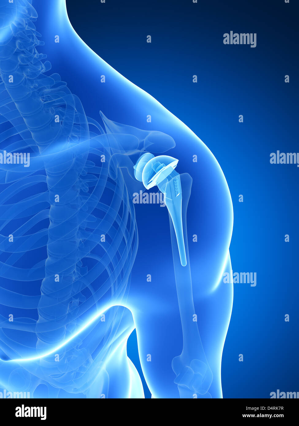 Shoulder implant hi-res stock photography and images - Alamy