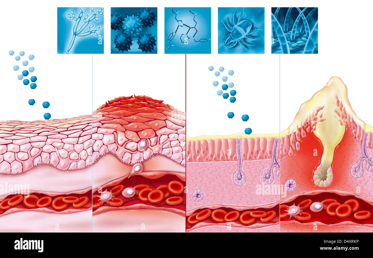 ALLERGY, DRAWING Stock Photo