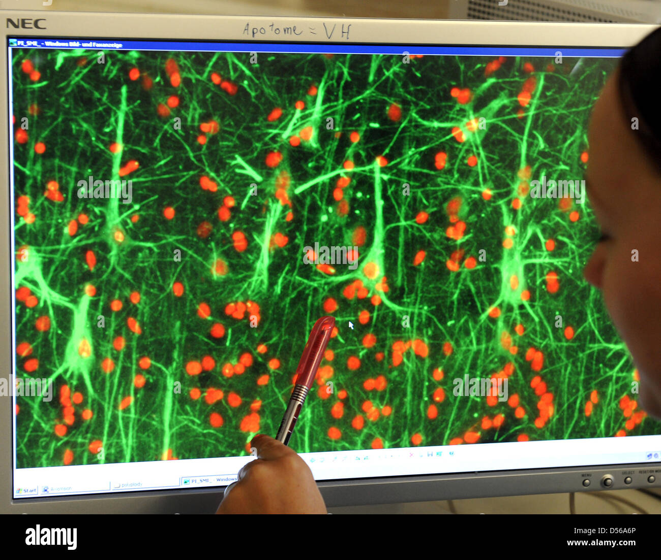 Alzheimer brain tissue hi-res stock photography and images - Alamy