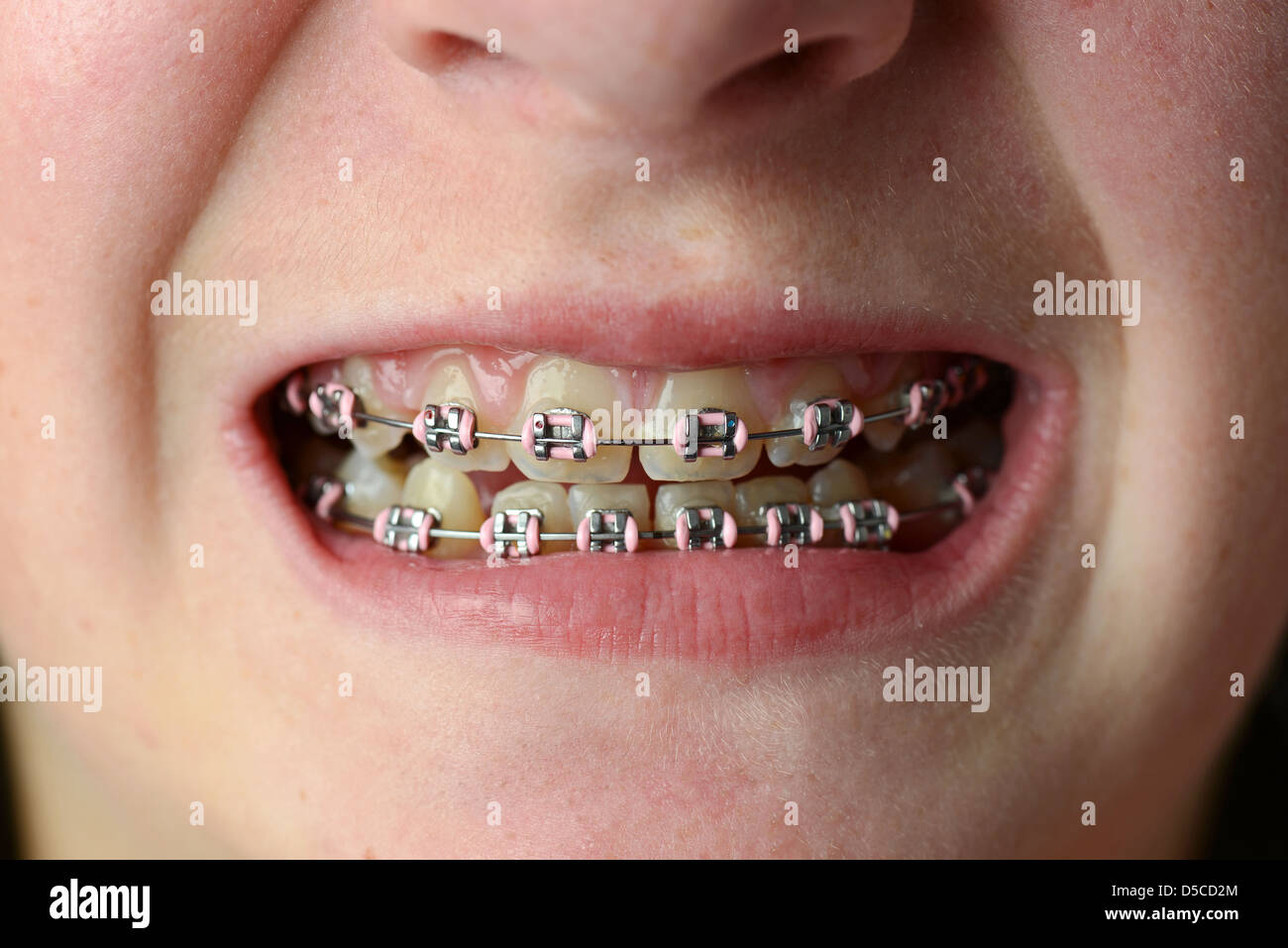 Braces, dental braces, close-up of teeth and braces, orthodontic braces Stock Photo