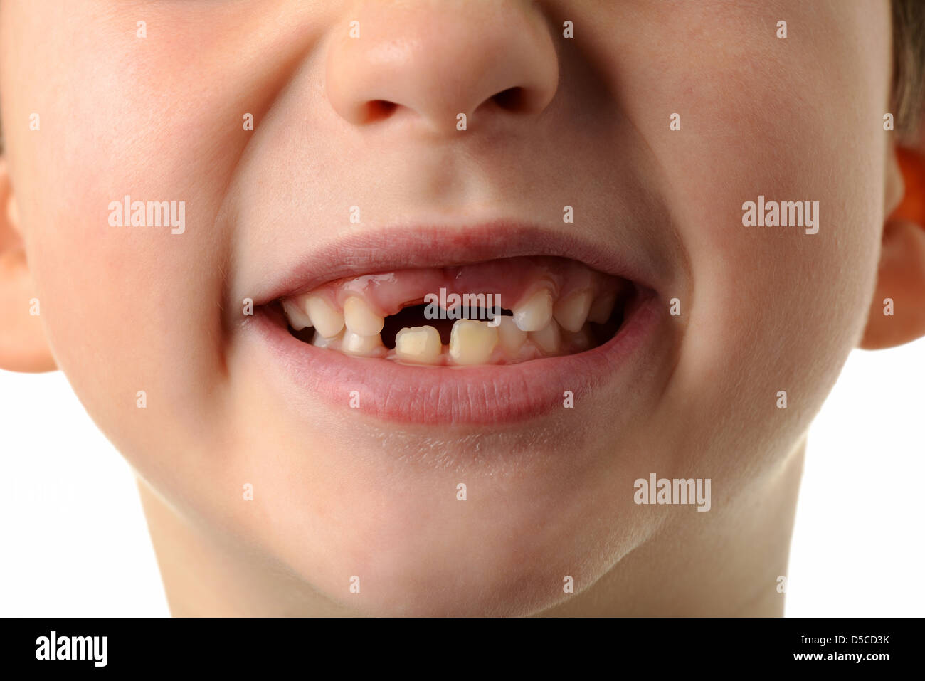 Child missing his two top teeth, close-up of mouth of boy showing his two top teeth missing. Stock Photo