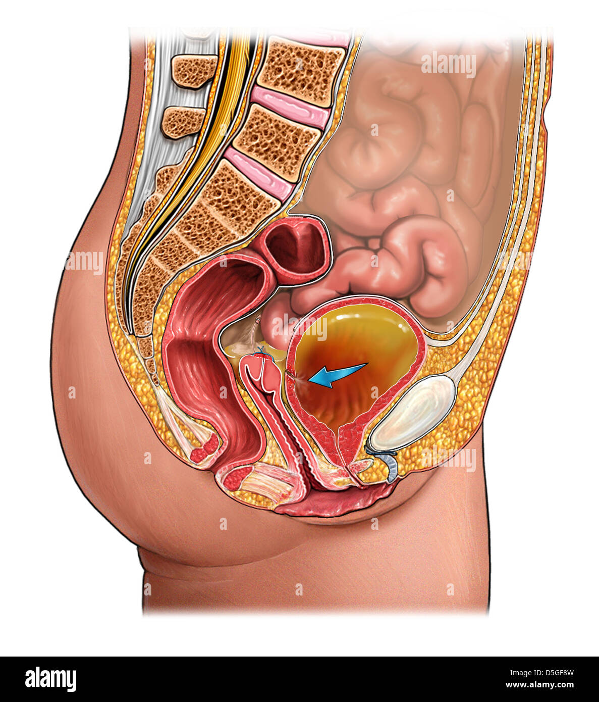 Hysterectomy and Perforation of Urinary Bladder Stock Photo