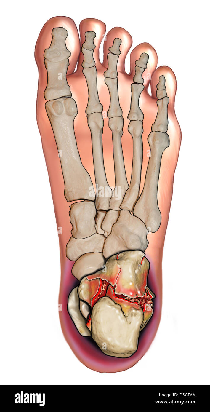 Comminuted Calcaneal Fracture - Plantar View Stock Photo