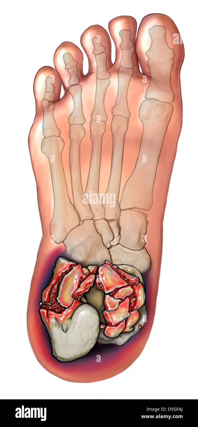 Comminuted Calcaneal Fracture Stock Photo