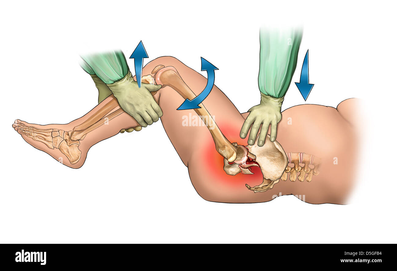 Closed Reduction of Hip Displacement Stock Photo