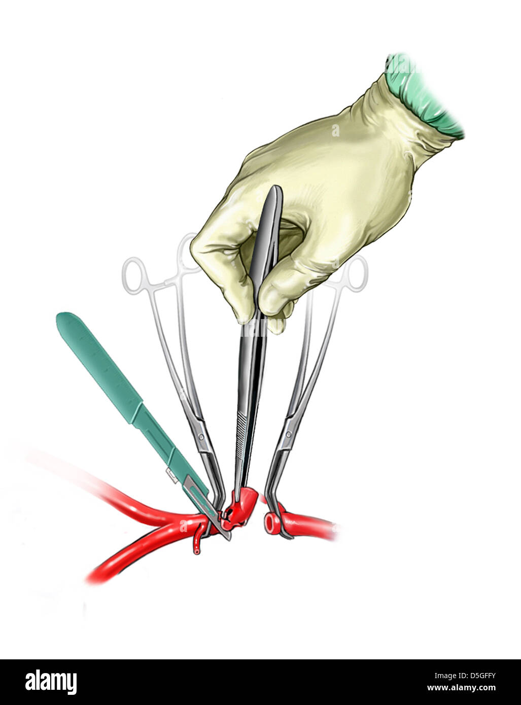 Resection of Injured Segment of Abdominal Aorta Stock Photo