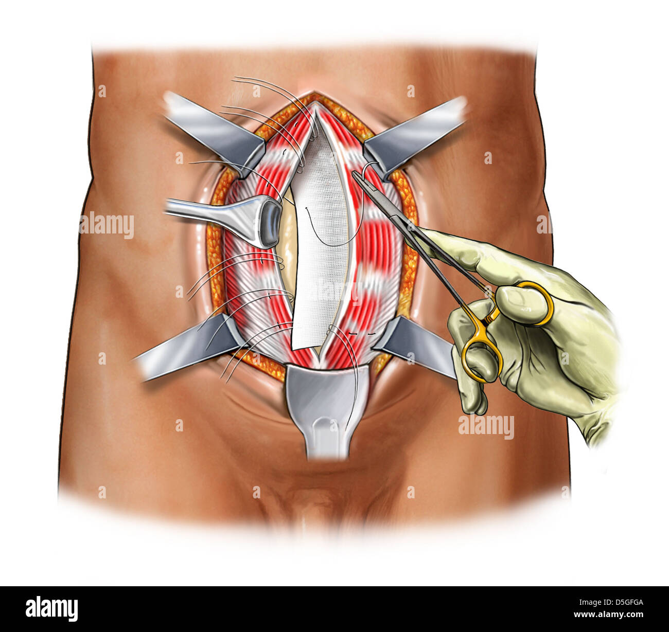 Abdominal Placement of Permacol Mesh Stock Photo: 55067834 ...