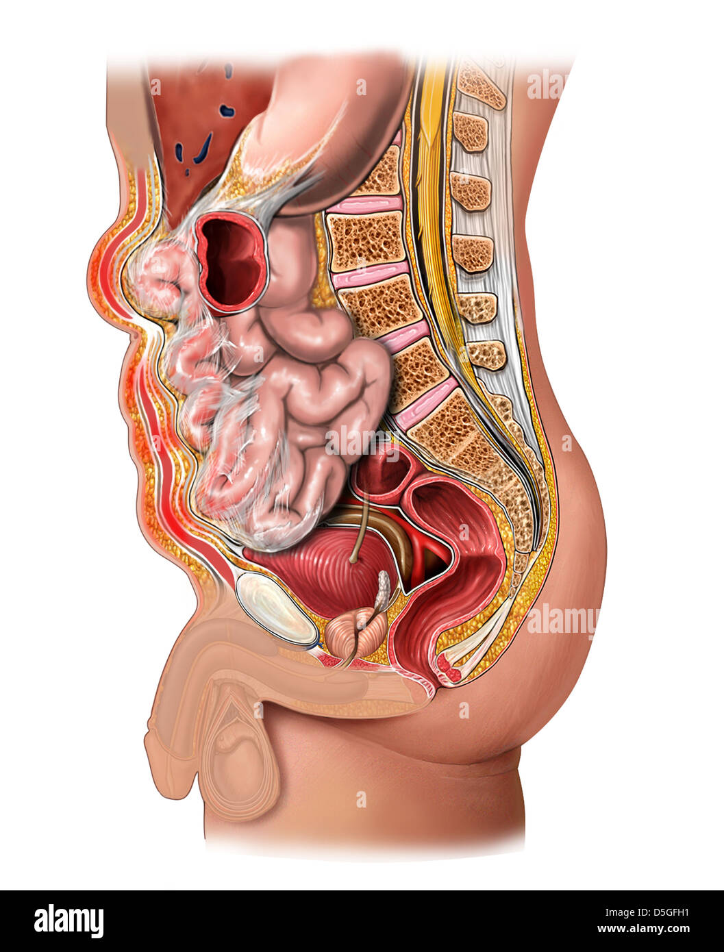 Multiple Incisional Hernias and Adhesions Stock Photo