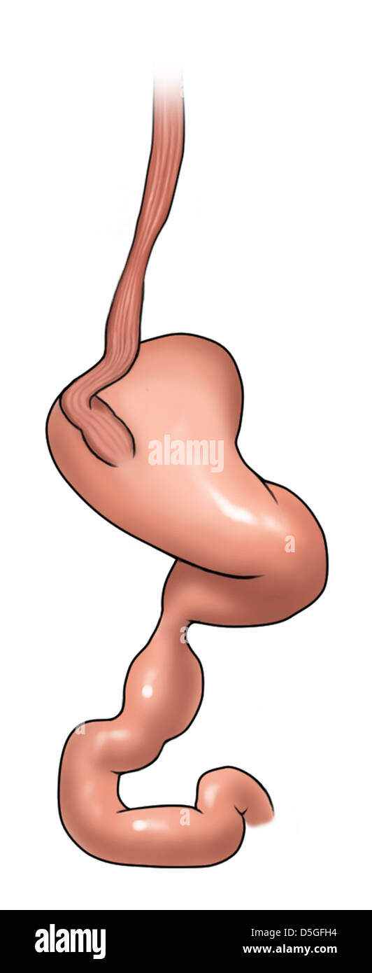Hiatal hernia hi-res stock photography and images - Alamy