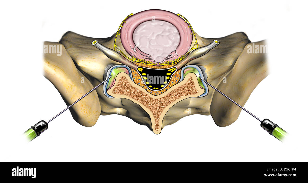 L5S1 Bilateral Facet Block Injection Stock Photo