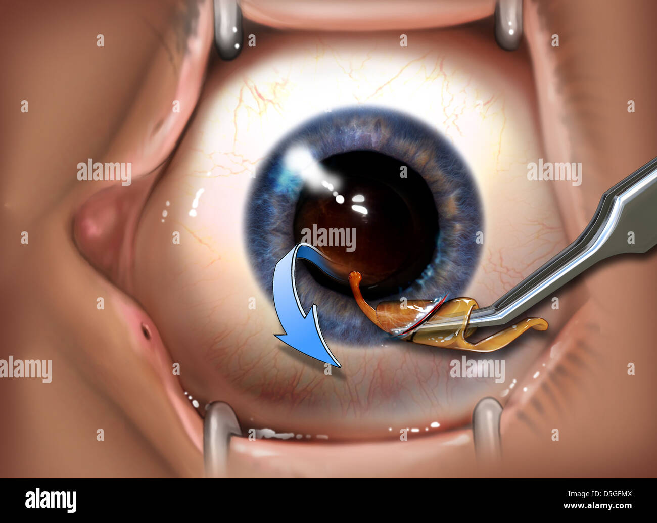 Intraocular Lens Placement Surgery Stock Photo