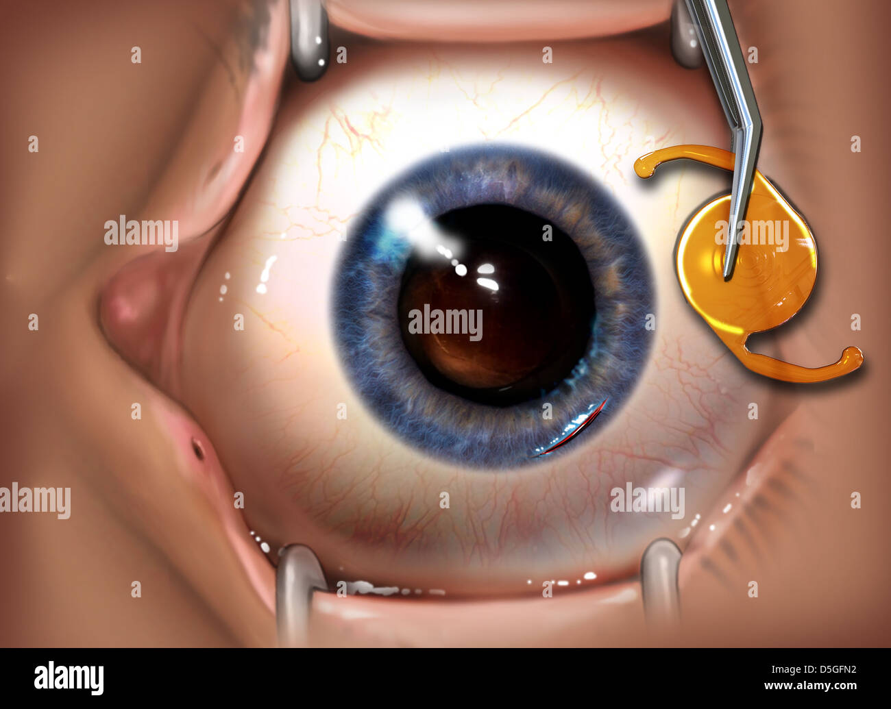 Intraocular Lens Placement Surgery Stock Photo Alamy