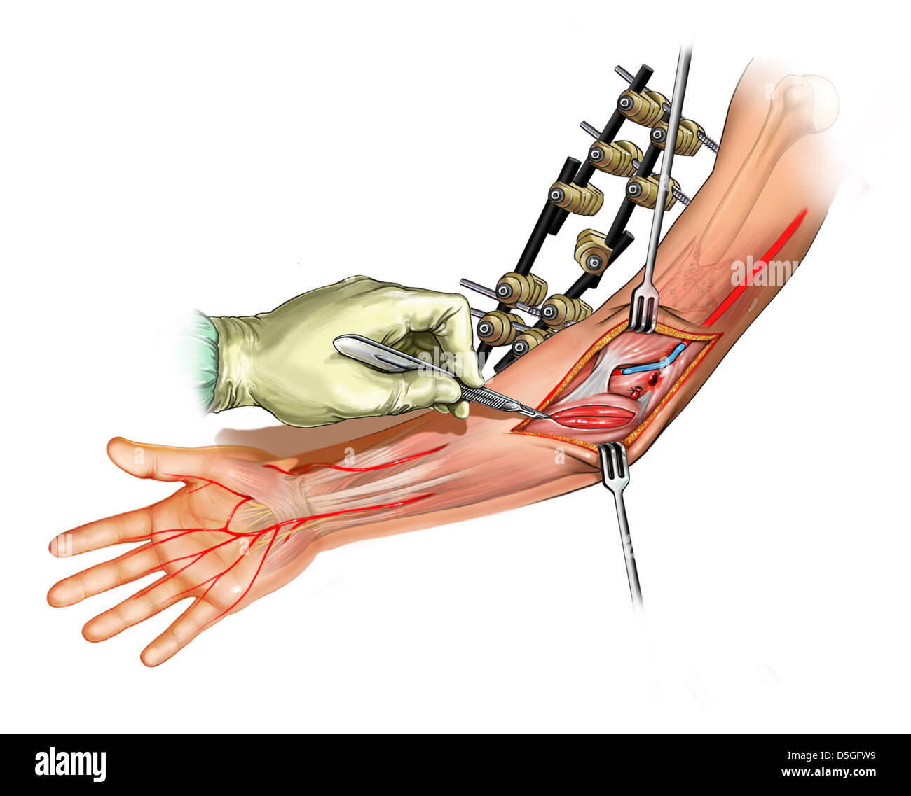 Fasciotomy hires stock photography and images Alamy